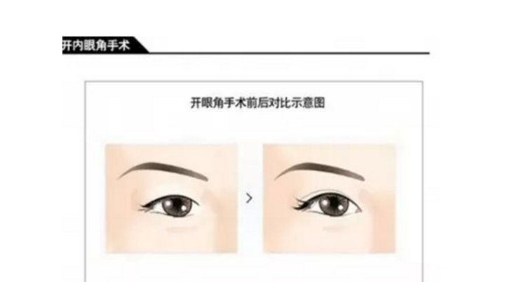 割双眼皮开眼角