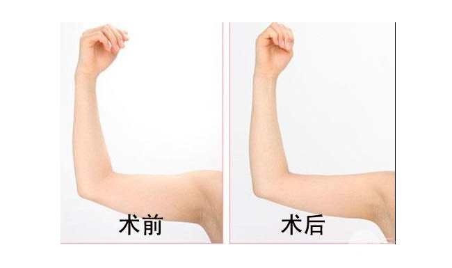 手臂吸脂手术要穿多长时间瘦身衣?