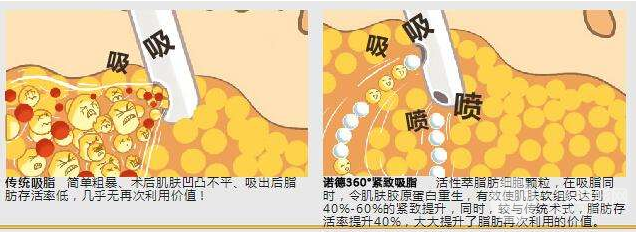 背部吸脂前后的变化 果对比图