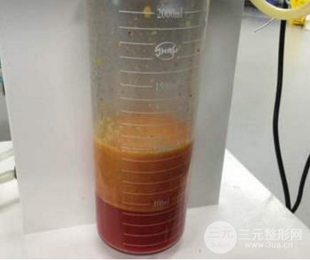 背部吸脂前后的变化 果对比图