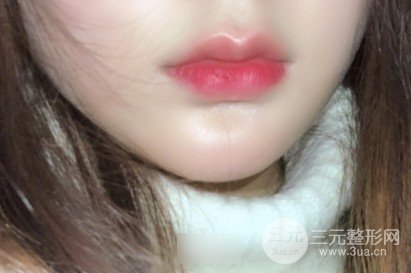 透明质酸丰唇