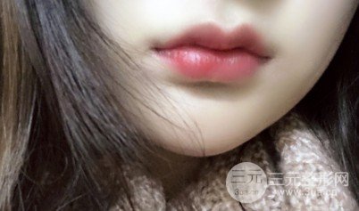 透明质酸丰唇