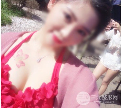 美国麦格假体隆胸