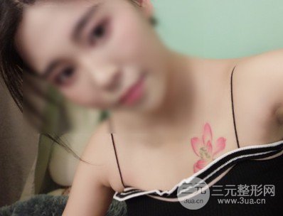 美国麦格假体隆胸