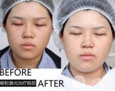 黑脸娃娃手术适应人群解读，哪些人做更降低风险?