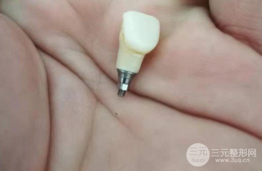 岭南牙科种植牙案例