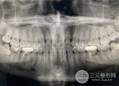 岭南牙科种植牙案例