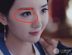 从毛晓彤开眼角留疤图片来说说开眼角后如何避免疤痕？