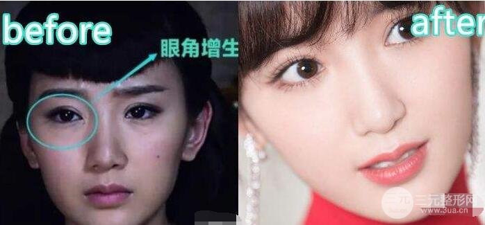毛晓彤开眼角留疤图片