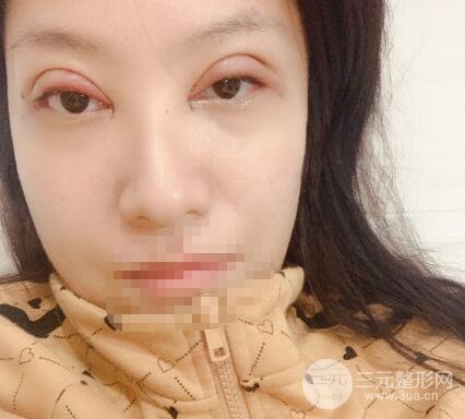 开眼角手术