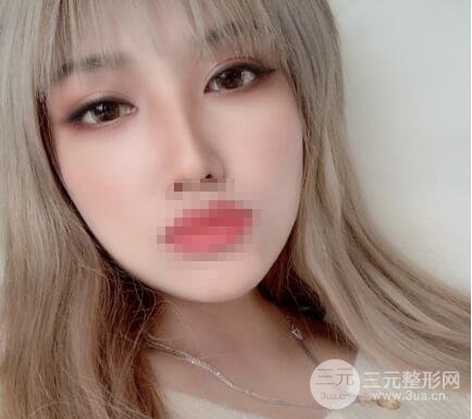 开眼角手术