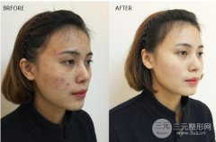 像素激光果真的有吗?来瞧一眼真人案例~