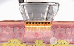 光子嫩肤面部皱纹成好吗?专家：作用有限