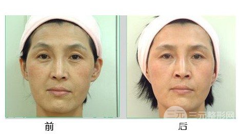 去鱼尾纹的办法