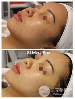 光子嫩肤面部皱纹成好吗
