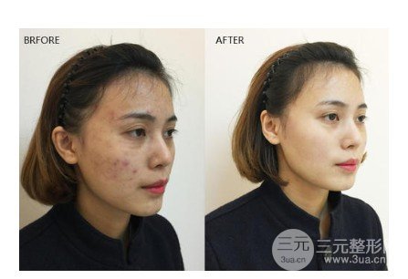 公立医院做光子嫩肤术要多少钱