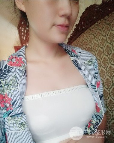 娜绮丽假体隆胸手术日记