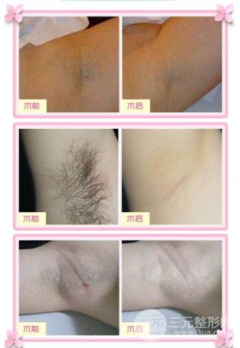 微创去除狐臭是什么