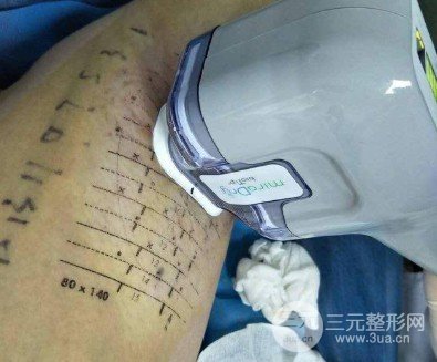 微创去除狐臭是什么