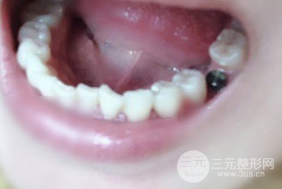 邵阳雅贝康口腔种植牙