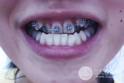 邵阳雅贝康口腔矫正案例