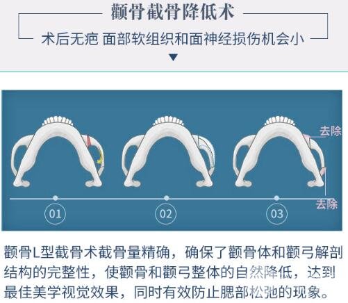 磨骨削骨适合哪些人做