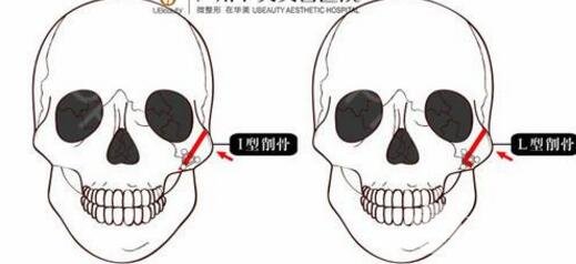 磨骨瘦脸十年后图片