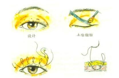 双眼皮手术后的护理;