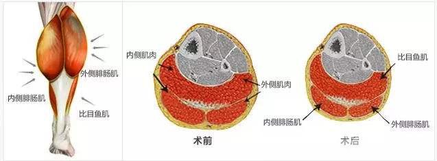 上海丽质医院卢九宁显微瘦小腿怎么样？医生介绍+果图对比~