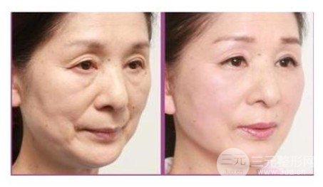 鱼尾纹除皱方法有哪些