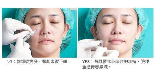 鱼尾纹除皱方法有哪些