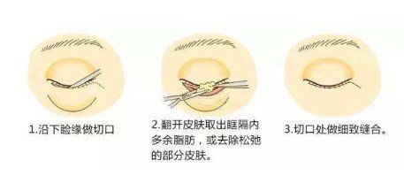 眼袋大别做内切祛眼袋