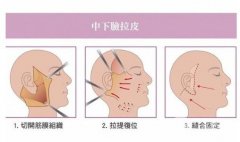 隐藏年龄的秘密—面部拉皮除皱多少岁做合适? 隐藏年龄的秘密—面部拉皮除皱多少岁做合适?