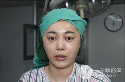 面部拉皮除皱多少岁做合适