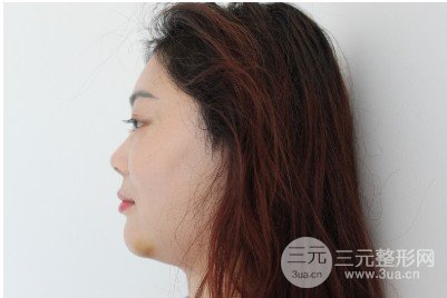 面部拉皮除皱多少岁做合适