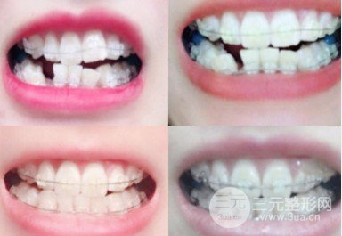 菏泽美尔口腔正畸案例