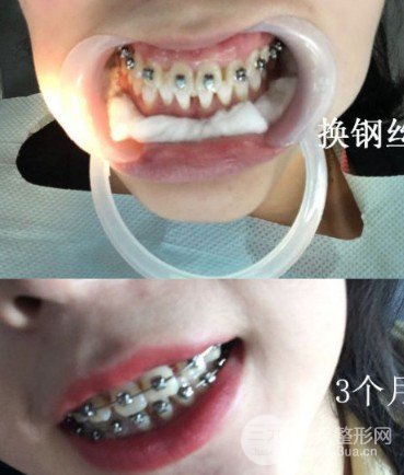 三门峡口腔医院牙缝大牙齿矫正案例