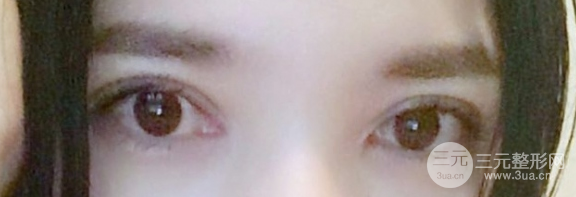 开眼角和不开的区别图