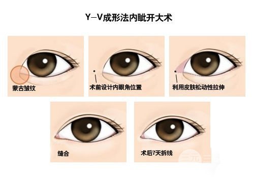 开眼角手术