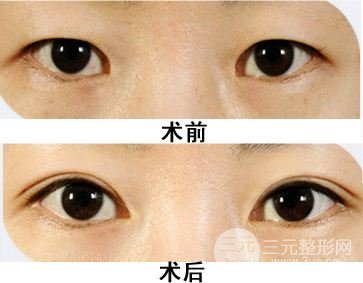 开眼角和不开的区别图