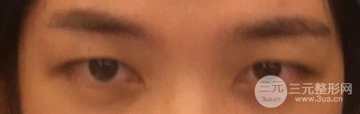 开眼角和不开的区别图