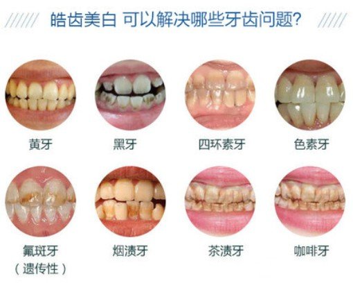 皓齿美白牙齿多少钱