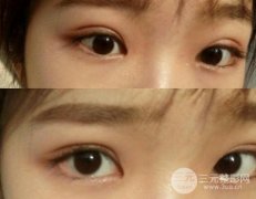 眼角上扬整形前后图片，要妩媚不要凶狠~