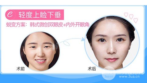 眼角上扬整形前后图片