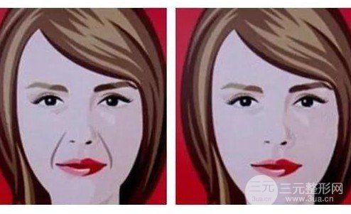 玻尿酸丰鼻唇沟