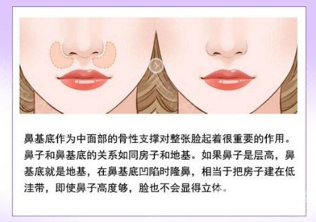 玻尿酸丰鼻唇沟