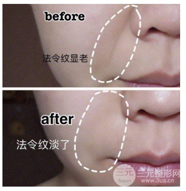 玻尿酸丰鼻唇沟