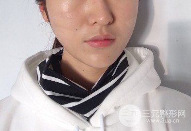 玻尿酸丰鼻唇沟