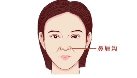 玻尿酸丰鼻唇沟