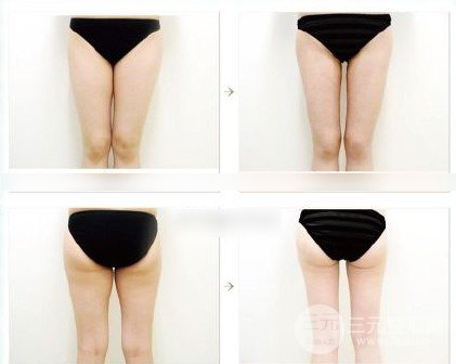 臀部吸脂塑形有果吗